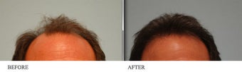 Hair Transplant