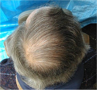 Hair Transplantation