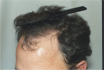 Hair Transplantation