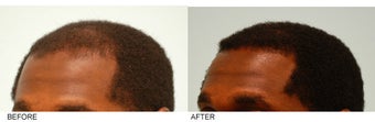 Hair Transplant