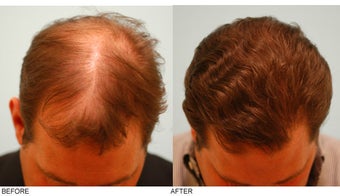 Hair Transplant