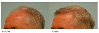 Hair Transplant