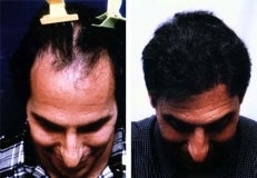 Hair replacement with Fleming/Mayer flap