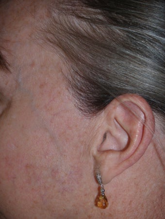 Reconstruction of sideburns with hair transplants lost as a result of prior facelift
