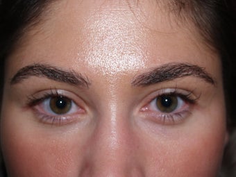 Eyebrow transplant