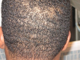 Hair Transplant - FUE 350 grafts