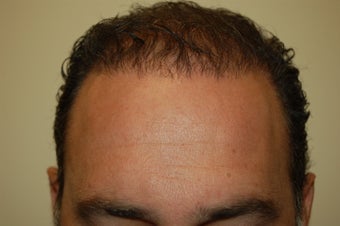 hair transplantation using Neograft