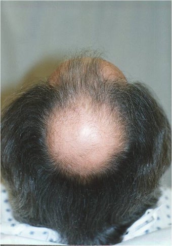 Hair Transplantation