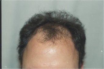 Hair Transplantation