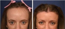 Hairline lowering