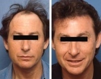 Hair replacement 