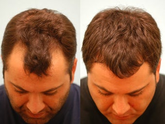 Hair Transplant