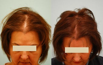 Female Hair Transplant