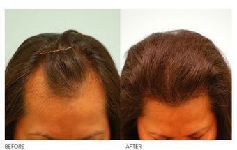 Female Hair Transplant
