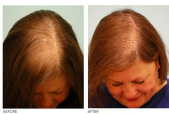 Female Hair Transplant
