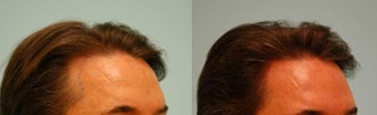 Hair Transplant