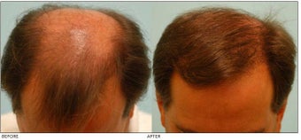 Hair Transplant