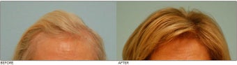 Female Hair Transplant