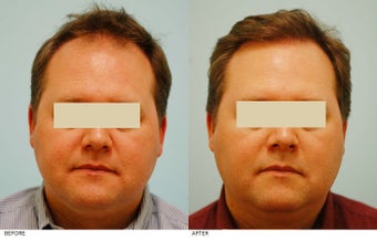 Hair Transplant