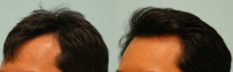 Hair Transplant