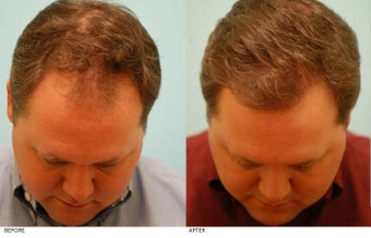 Hair Transplant