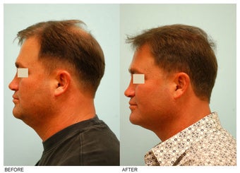 Crown (Vertex) Hair Transplant