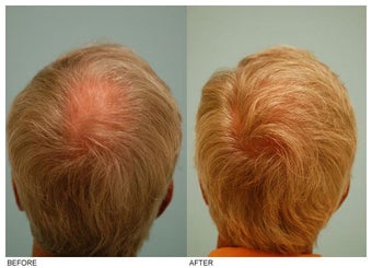 Crown (Vertex) Hair Transplant