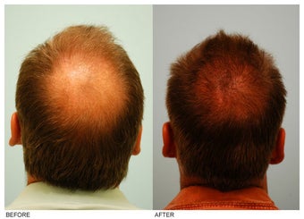 Crown (Vertex) Hair Transplant