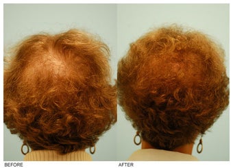 Crown (Vertex) Hair Transplant