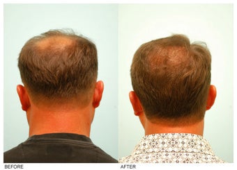 Crown (Vertex) Hair Transplant