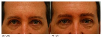Eyebrow Hair Transplant