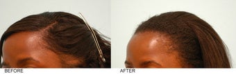 Female Hair Transplant