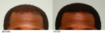 Hair Transplant