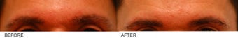 Eyebrow Hair Transplant