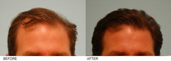 Hair Transplant