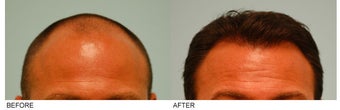 Hair Transplant