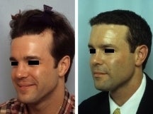 Hair replacement with Fleming/Mayer flap
