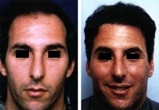 Hair replacement with Fleming/Mayer flap