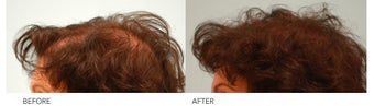 Female Hair Transplant