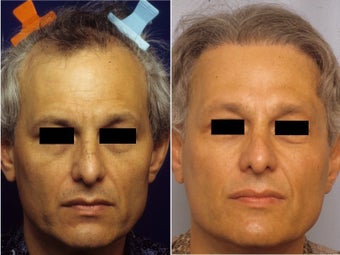 Hair replacement