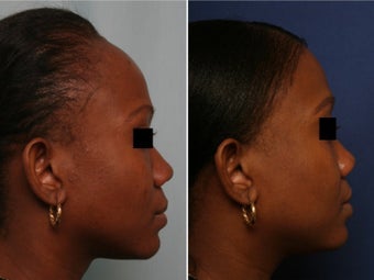 Hairline lowering