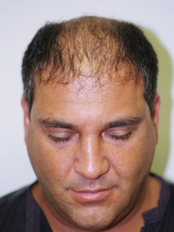 Hair Transplant-  2800 grafts