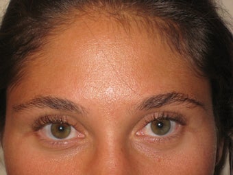 Eyebrow transplant