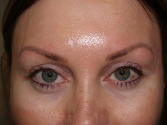 Eyebrow transplant 