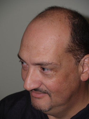 Hair Transplant - 3400 grafts