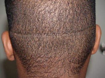 Hair Transplant - FUE 350 grafts