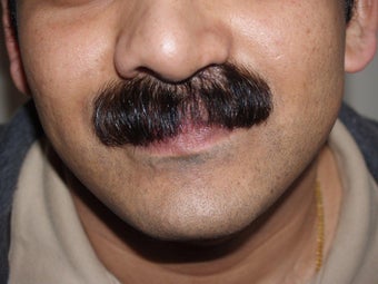 Facial Hair Transplant