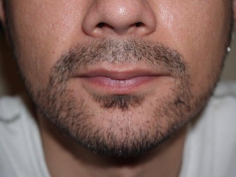 Facial Hair Transplant
