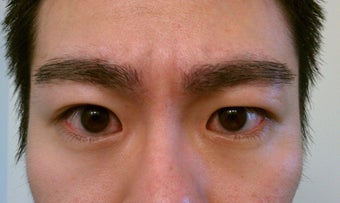 Eyebrow Transplant