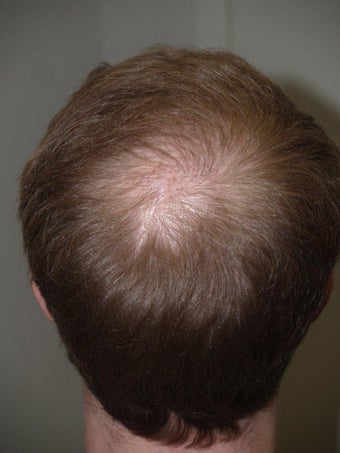 Hair Transplant 